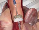 therapeia aortikes stenoses me